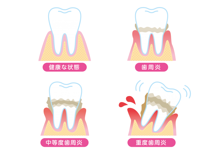 歯周病の進行過程