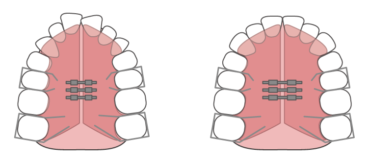 小児矯正のメリット
