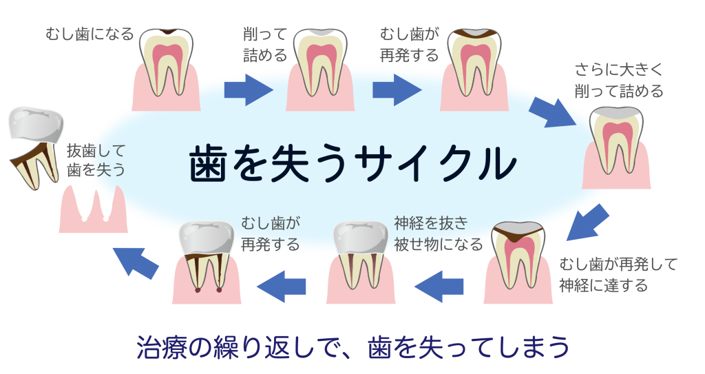 図：歯を失うサイクル