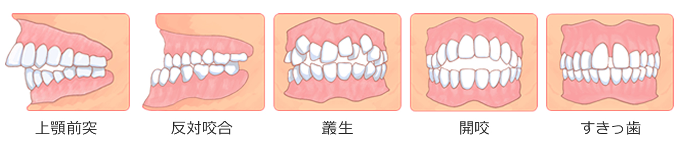 図：不正歯列の種類