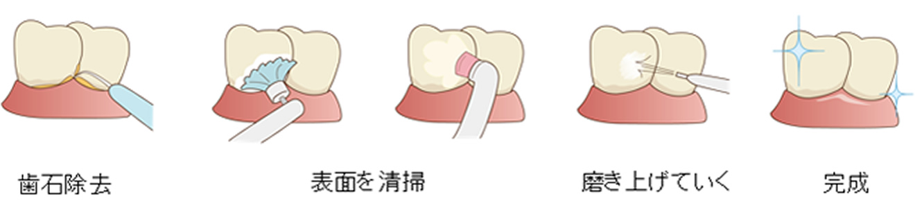図：歯クリーニング